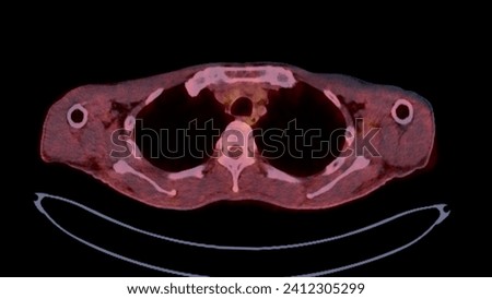 A PET-CT scan image is a diagnostic visualization combining Positron Emission Tomography (PET) and Computed Tomography (CT) for Helps in finding cancer recurrence.