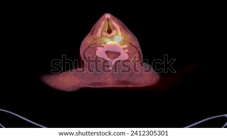 A PET-CT scan image is a diagnostic visualization combining Positron Emission Tomography (PET) and Computed Tomography (CT) for Helps in finding cancer recurrence.