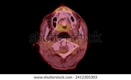 A PET-CT scan image is a diagnostic visualization combining Positron Emission Tomography (PET) and Computed Tomography (CT) for Helps in finding cancer recurrence.
