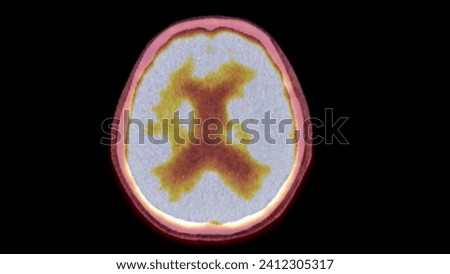A PET-CT scan image is a diagnostic visualization combining Positron Emission Tomography (PET) and Computed Tomography (CT) for Helps in finding cancer recurrence.
