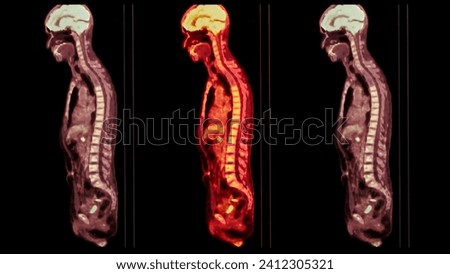 A PET-CT scan image is a diagnostic visualization combining Positron Emission Tomography (PET) and Computed Tomography (CT) for Helps in finding cancer recurrence.