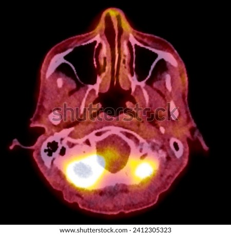A PET-CT scan image is a diagnostic visualization combining Positron Emission Tomography (PET) and Computed Tomography (CT) for Helps in finding cancer recurrence.