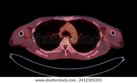 A PET-CT scan image is a diagnostic visualization combining Positron Emission Tomography (PET) and Computed Tomography (CT) for Helps in finding cancer recurrence.