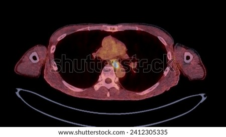 A PET-CT scan image is a diagnostic visualization combining Positron Emission Tomography (PET) and Computed Tomography (CT) for Helps in finding cancer recurrence.