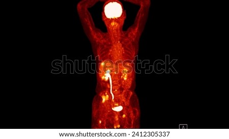 A PET-CT scan image is a diagnostic visualization combining Positron Emission Tomography (PET) and Computed Tomography (CT) for Helps in finding cancer recurrence.