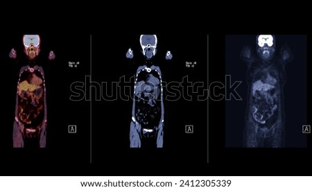 A PET-CT scan image is a diagnostic visualization combining Positron Emission Tomography (PET) and Computed Tomography (CT) for Helps in finding cancer recurrence.