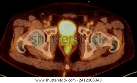 A PET-CT scan image is a diagnostic visualization combining Positron Emission Tomography (PET) and Computed Tomography (CT) for Helps in finding cancer recurrence.