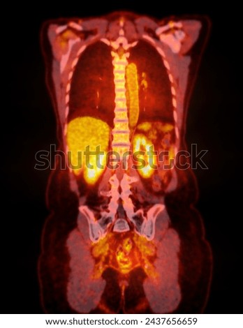 A PET-CT scan image is a diagnostic visualization combining Positron Emission Tomography (PET) and Computed Tomography (CT) for Helps in finding cancer recurrence.