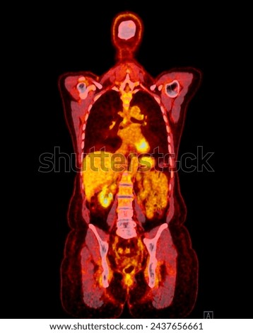 A PET-CT scan image is a diagnostic visualization combining Positron Emission Tomography (PET) and Computed Tomography (CT) for Helps in finding cancer recurrence.