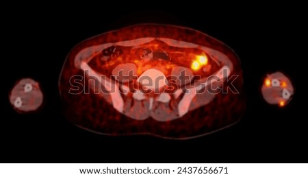 A PET-CT scan image is a diagnostic visualization combining Positron Emission Tomography (PET) and Computed Tomography (CT) for Helps in finding cancer recurrence.