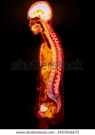 A PET-CT scan image is a diagnostic visualization combining Positron Emission Tomography (PET) and Computed Tomography (CT) for Helps in finding cancer recurrence.