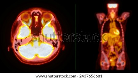 A PET-CT scan image is a diagnostic visualization combining Positron Emission Tomography (PET) and Computed Tomography (CT) for Helps in finding cancer recurrence.