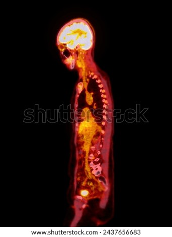 A PET-CT scan image is a diagnostic visualization combining Positron Emission Tomography (PET) and Computed Tomography (CT) for Helps in finding cancer recurrence.