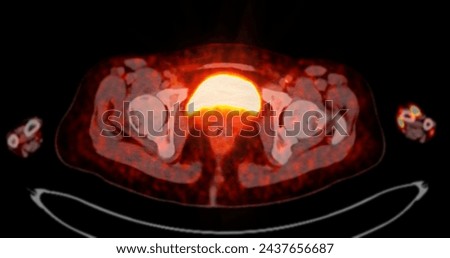 A PET-CT scan image is a diagnostic visualization combining Positron Emission Tomography (PET) and Computed Tomography (CT) for Helps in finding cancer recurrence.