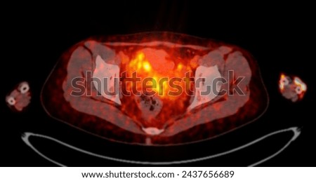 A PET-CT scan image is a diagnostic visualization combining Positron Emission Tomography (PET) and Computed Tomography (CT) for Helps in finding cancer recurrence.