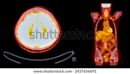 A PET-CT scan image is a diagnostic visualization combining Positron Emission Tomography (PET) and Computed Tomography (CT) for Helps in finding cancer recurrence.