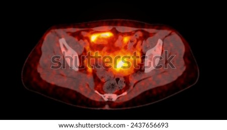 A PET-CT scan image is a diagnostic visualization combining Positron Emission Tomography (PET) and Computed Tomography (CT) for Helps in finding cancer recurrence.