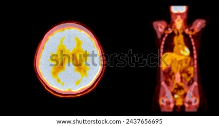 A PET-CT scan image is a diagnostic visualization combining Positron Emission Tomography (PET) and Computed Tomography (CT) for Helps in finding cancer recurrence.