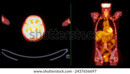 A PET-CT scan image is a diagnostic visualization combining Positron Emission Tomography (PET) and Computed Tomography (CT) for Helps in finding cancer recurrence.