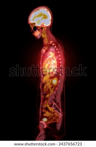 A PET-CT scan image is a diagnostic visualization combining Positron Emission Tomography (PET) and Computed Tomography (CT) for Helps in finding cancer recurrence.