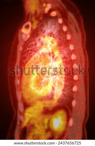 A PET-CT scan image is a diagnostic visualization combining Positron Emission Tomography (PET) and Computed Tomography (CT) for Helps in finding cancer recurrence.