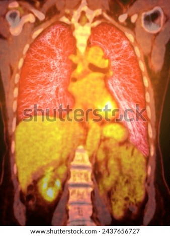 A PET-CT scan image is a diagnostic visualization combining Positron Emission Tomography (PET) and Computed Tomography (CT) for Helps in finding cancer recurrence.