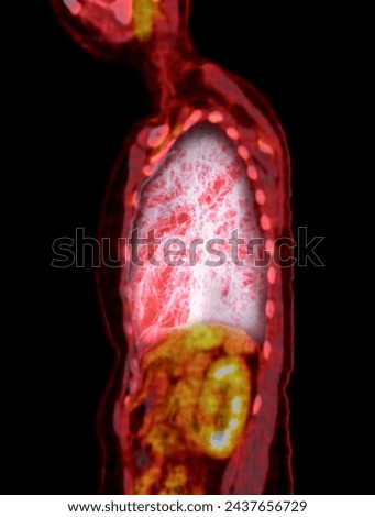 A PET-CT scan image is a diagnostic visualization combining Positron Emission Tomography (PET) and Computed Tomography (CT) for Helps in finding cancer recurrence.