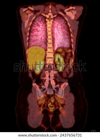 A PET-CT scan image is a diagnostic visualization combining Positron Emission Tomography (PET) and Computed Tomography (CT) for Helps in finding cancer recurrence.