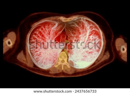 A PET-CT scan image is a diagnostic visualization combining Positron Emission Tomography (PET) and Computed Tomography (CT) for Helps in finding cancer recurrence.