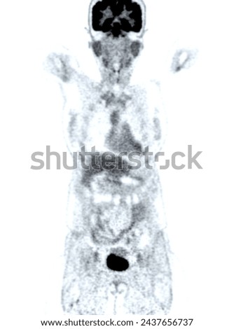 A PET-CT scan image is a diagnostic visualization combining Positron Emission Tomography (PET) and Computed Tomography (CT) for Helps in finding cancer recurrence.