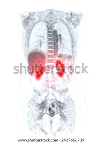 A PET-CT scan image is a diagnostic visualization combining Positron Emission Tomography (PET) and Computed Tomography (CT) for Helps in finding cancer recurrence.