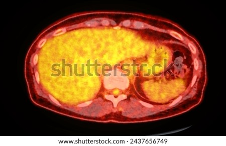 A PET-CT scan image is a diagnostic visualization combining Positron Emission Tomography (PET) and Computed Tomography (CT) for Helps in finding cancer recurrence.