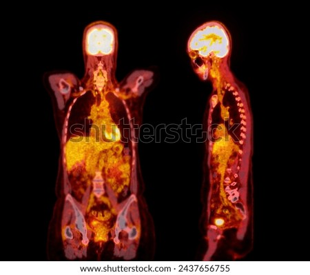 A PET-CT scan image is a diagnostic visualization combining Positron Emission Tomography (PET) and Computed Tomography (CT) for Helps in finding cancer recurrence.