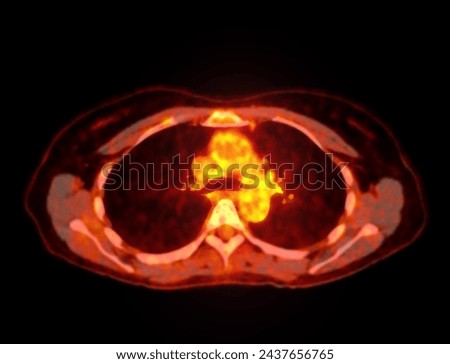 A PET-CT scan image is a diagnostic visualization combining Positron Emission Tomography (PET) and Computed Tomography (CT) for Helps in finding cancer recurrence.