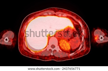 A PET-CT scan image is a diagnostic visualization combining Positron Emission Tomography (PET) and Computed Tomography (CT) for Helps in finding cancer recurrence.