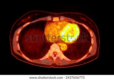 A PET-CT scan image is a diagnostic visualization combining Positron Emission Tomography (PET) and Computed Tomography (CT) for Helps in finding cancer recurrence.