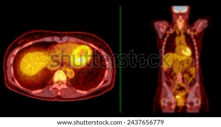 A PET-CT scan image is a diagnostic visualization combining Positron Emission Tomography (PET) and Computed Tomography (CT) for Helps in finding cancer recurrence.