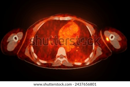 A PET-CT scan image is a diagnostic visualization combining Positron Emission Tomography (PET) and Computed Tomography (CT) for Helps in finding cancer recurrence.