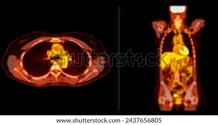 A PET-CT scan image is a diagnostic visualization combining Positron Emission Tomography (PET) and Computed Tomography (CT) for Helps in finding cancer recurrence.