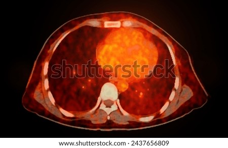 A PET-CT scan image is a diagnostic visualization combining Positron Emission Tomography (PET) and Computed Tomography (CT) for Helps in finding cancer recurrence.
