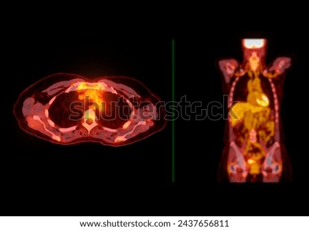 A PET-CT scan image is a diagnostic visualization combining Positron Emission Tomography (PET) and Computed Tomography (CT) for Helps in finding cancer recurrence.