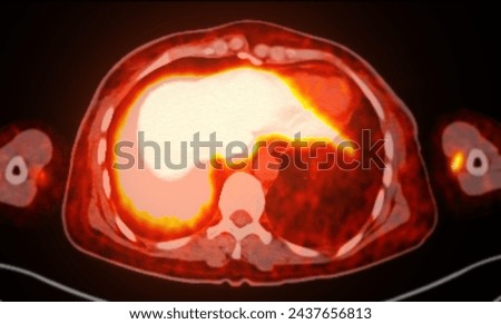 A PET-CT scan image is a diagnostic visualization combining Positron Emission Tomography (PET) and Computed Tomography (CT) for Helps in finding cancer recurrence.