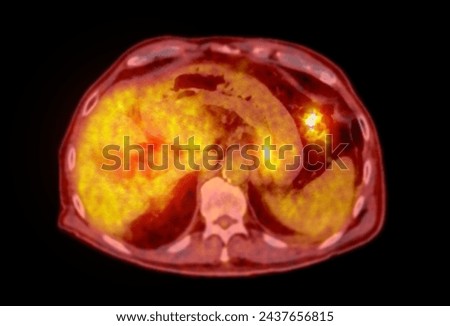 A PET-CT scan image is a diagnostic visualization combining Positron Emission Tomography (PET) and Computed Tomography (CT) for Helps in finding cancer recurrence.