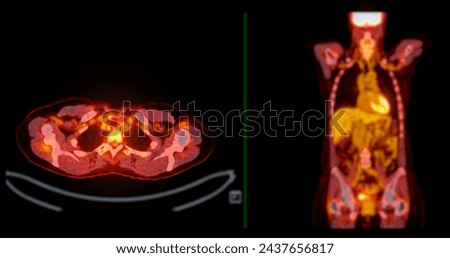 A PET-CT scan image is a diagnostic visualization combining Positron Emission Tomography (PET) and Computed Tomography (CT) for Helps in finding cancer recurrence.
