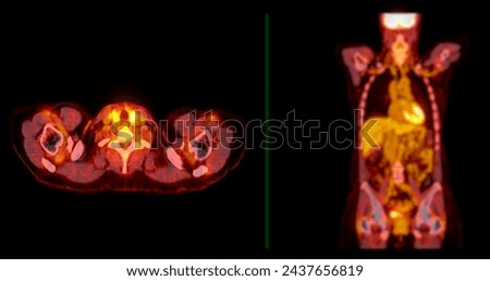A PET-CT scan image is a diagnostic visualization combining Positron Emission Tomography (PET) and Computed Tomography (CT) for Helps in finding cancer recurrence.