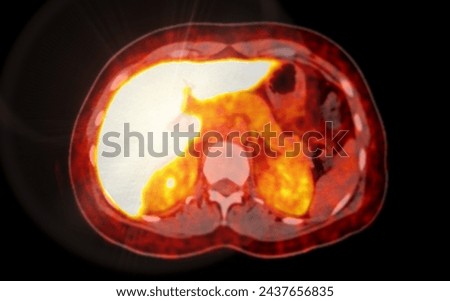 A PET-CT scan image is a diagnostic visualization combining Positron Emission Tomography (PET) and Computed Tomography (CT) for Helps in finding cancer recurrence.