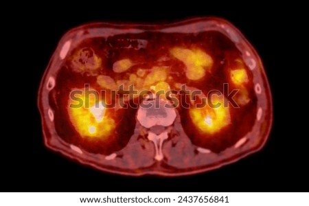 A PET-CT scan image is a diagnostic visualization combining Positron Emission Tomography (PET) and Computed Tomography (CT) for Helps in finding cancer recurrence.