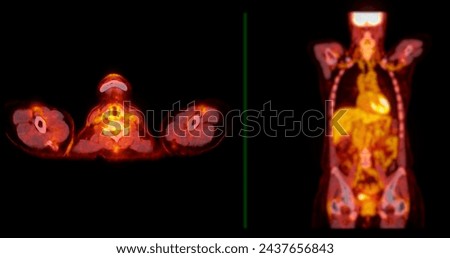 A PET-CT scan image is a diagnostic visualization combining Positron Emission Tomography (PET) and Computed Tomography (CT) for Helps in finding cancer recurrence.