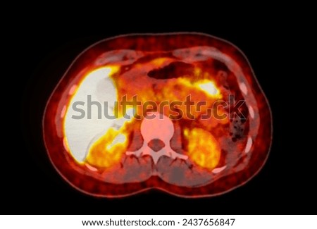 A PET-CT scan image is a diagnostic visualization combining Positron Emission Tomography (PET) and Computed Tomography (CT) for Helps in finding cancer recurrence.
