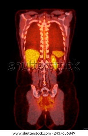 A PET-CT scan image is a diagnostic visualization combining Positron Emission Tomography (PET) and Computed Tomography (CT) for Helps in finding cancer recurrence.
